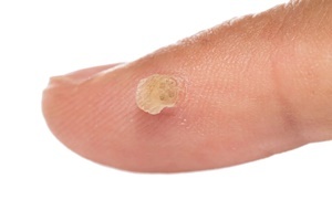Một mụn cóc là một bệnh da mà hiệu quả chiến đấu Skincell Pro